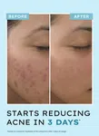 Acne Defence Daily Serum 30 ml - Available at AfnoBazar Nepal