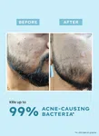 Clarifying Acne Cleanser 100 ml - Available at AfnoBazar Nepal