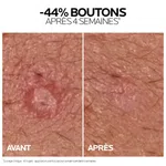 La Roche-Posay Effaclar Duo+M Acne Treatment Cream, 40ml - Available at AfnoBazar Nepal