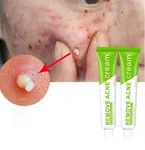 LUNDBORLY Acne Removal Cream, 20g - Available at AfnoBazar Nepal