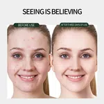 LUNDBORLY Acne Removal Cream, 20g - Available at AfnoBazar Nepal
