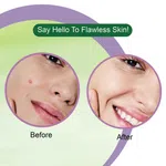 Dr. Rashel Neem Acne Pimple Patch with Salicylic Acid, 36 Patches - Available at AfnoBazar Nepal
