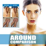 Vitiligo Care Ointment for White Spots and Leukoplakia, 20g - Available at AfnoBazar Nepal