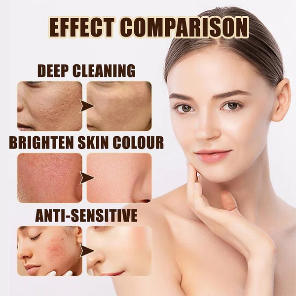 Herbal Skin Doctor Anti-Acne Cream, 30g, Olive or Aloe Vera - Available at AfnoBazar Nepal