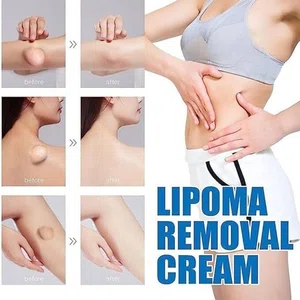 South Moon Lipoma Cream for Body Fat Lumps, Topical Herbal Formula - Available at AfnoBazar Nepal