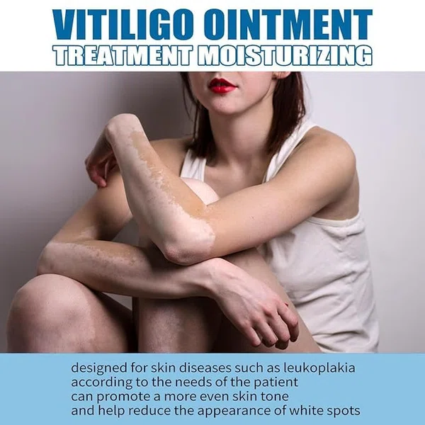 Vitiligo Care Ointment for White Spots and Leukoplakia, 20g - Available at AfnoBazar Nepal