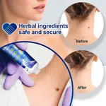 Wart Remover Ointment and Skin Tag Treatment Cream, 20g - Available at AfnoBazar Nepal