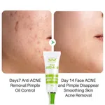 Herbal Skin Doctor Anti-Acne Cream, 30g, Olive or Aloe Vera - Available at AfnoBazar Nepal