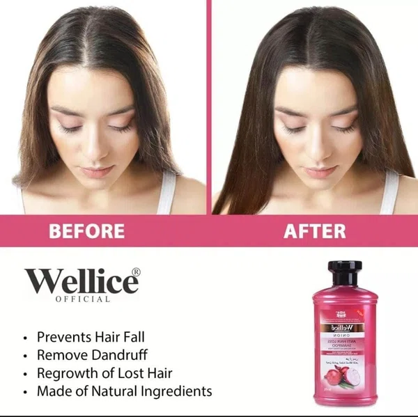 Wellice Advanced Onion Oil for Hair Growth, 150ml, Onion and Coconut Blend - Available at AfnoBazar Nepal
