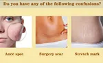 Scar and Acne Mark Removal Gel Ointment - Available at AfnoBazar Nepal