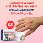 Lipoma Remover Cream - Targeted Skin Care Cream for Lipoma-Prone Areas - Available at AfnoBazar Nepal