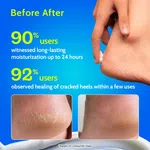 Chemist at Play 10% Urea Foot Cream for Cracked Heels - 50 g - Available at AfnoBazar Nepal