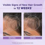 Bare Anatomy Rosemary & Hibiscus Hair Growth Oil with Redensyl & Biotin - 100 ml - Available at AfnoBazar Nepal
