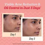 Chemist at Play Acne Control Face Serum with 2% Salicylic Acid & Lactic Acid - 10 ml - Available at AfnoBazar Nepal