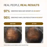 Bare Anatomy Advanced Hair Growth Serum Roll-On with 5% Rosemary & 3% Redensyl - 25 ml - Available at AfnoBazar Nepal