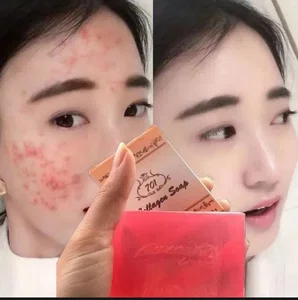 Collagen Acne Soap 701 | Pimple Removal & Oil Control | Skin Whitening & Acne Scar Treatment Face Soap