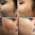 Pilgrim 10% Vitamin C Serum 30ml for Glowing Skin|With 5% Niacinamide, Hyaluronic & Glycolic Acid|Fades Dark Spots, Pigmentation|For All, Oily, Combination, Normal Skin |Beginner Friendly - Men, Women