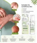 Eczemaron Anti Fungal Cream - Fast Relief From Eczema, Itching, Ringworm & Skin Infections - 50gm image 5