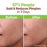 Mamaearth Tea Tree Pimple Control Face Wash with Tea Tree & Salicylic Acid - 100ml image 5